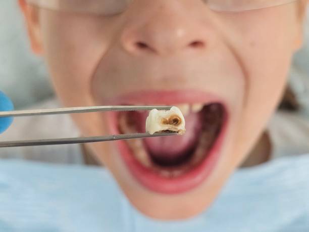 Best Emergency Treatment for Dental Infections or Abscesses in Untain View, MO